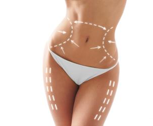 Liposucción y lipoescultura