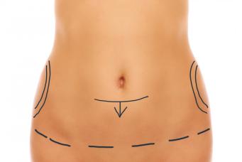 Abdominoplastia