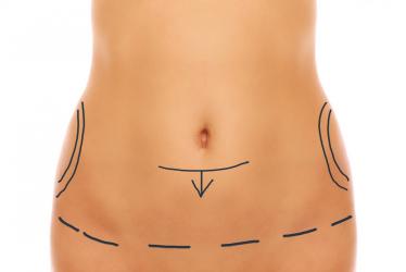 Abdominoplastia