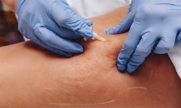 Carboxiterapia