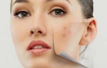 Eliminación de manchas faciales